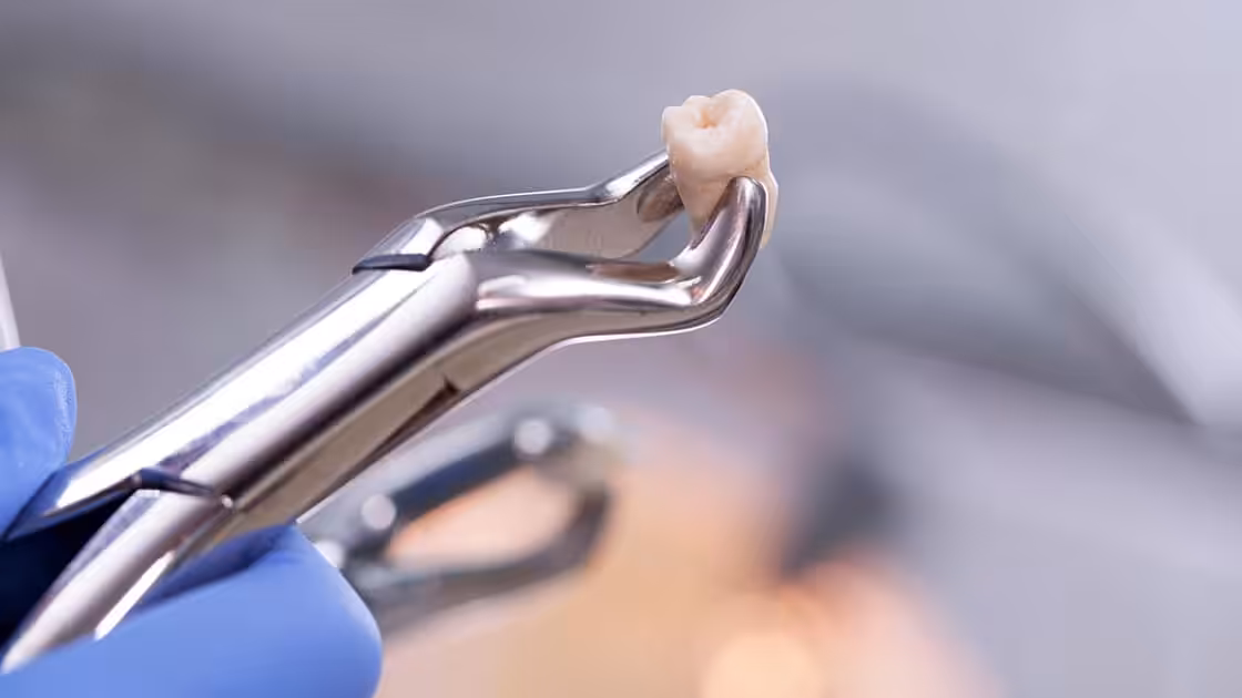 Holding an Extracted Tooth