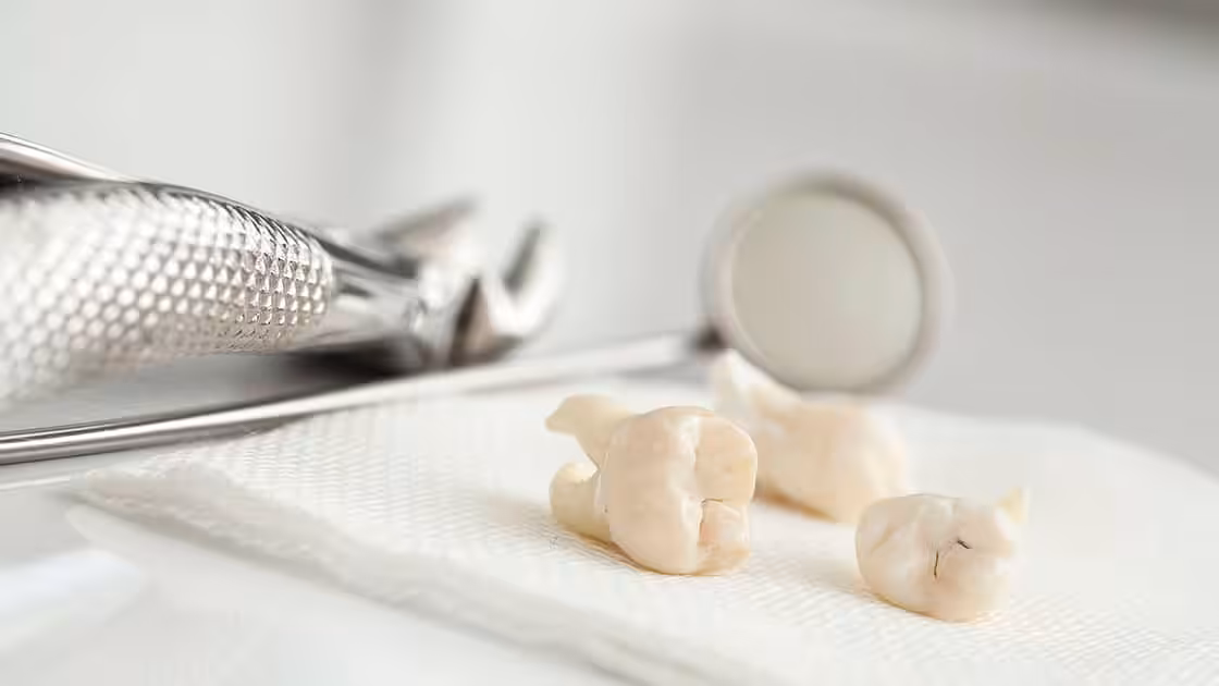 Dental Extractions