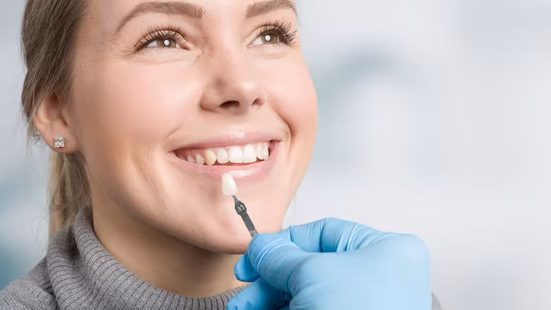 Veneers - Matching Color of Teeth