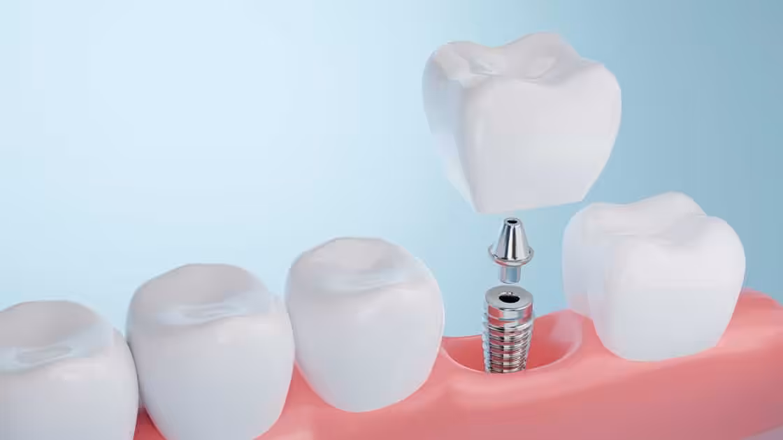 Implant dentistry