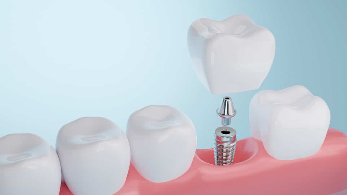 Implant dentistry